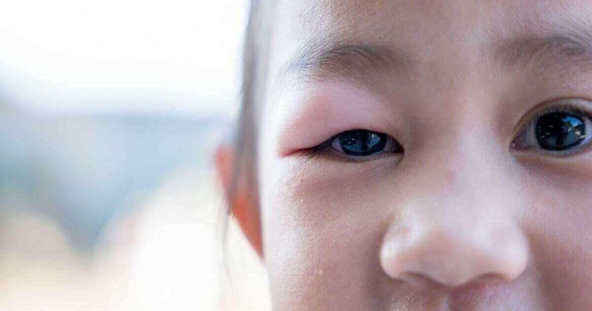 How To Treat A Stye On A Toddler