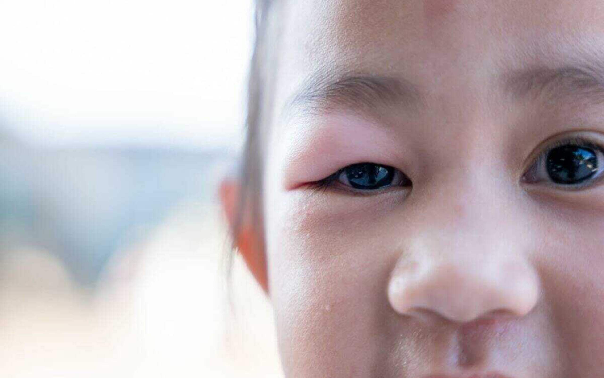 Children's Stye | Causes, Symptoms & Treatment for a Child's Stye